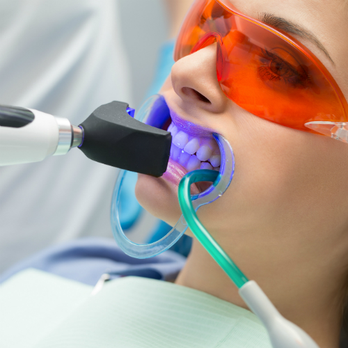 Bleaching-Methoden-beim-Zahnarzt.jpg